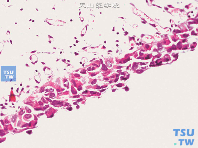 尿路上皮原位癌，上皮全层细胞异型显著，中层及表层细胞可见核分裂象。临床表现类似间质性膀胱炎，尿细胞学可见4级细胞