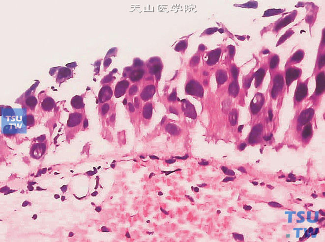 膀胱原位癌病理图谱