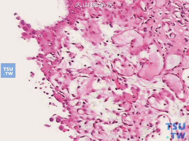 膀胱尿路上皮原位癌，示大部分表层上皮脱落
