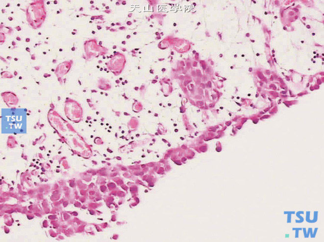 膀胱尿路上皮原位癌，示局部细胞异型增生明显，大部分上皮脱落。上皮下可见微小浸润