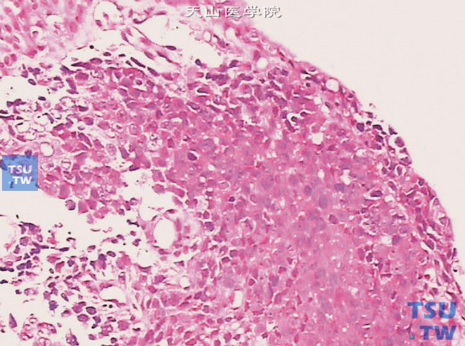 尿路上皮原位癌，示正常黏膜过渡为原位癌，并伴浸润性生长
