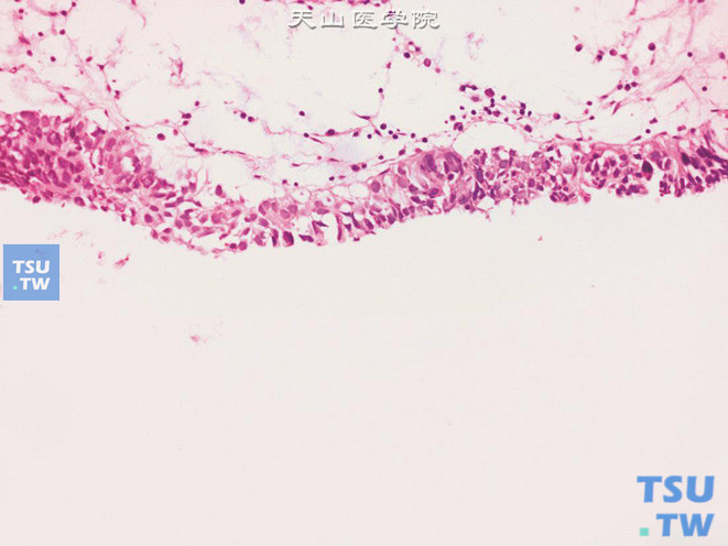 膀胱原位腺癌，平坦型。注意核异型性明显，累及黏膜表面