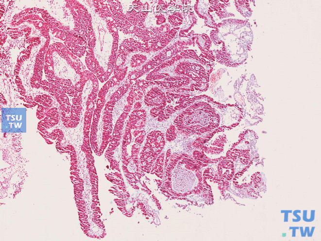 膀胱腺癌，筛孔状型