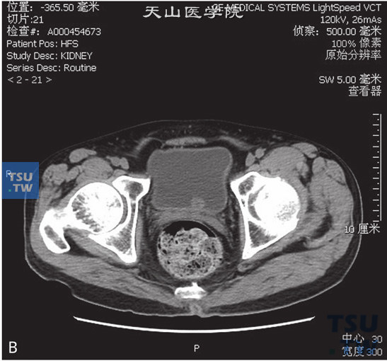 图B：CT膀胱移行上皮癌，男，62岁，全程无痛肉眼血尿1周。膀胱三角区见一蕈伞状软组织密度灶以窄基底与膀胱壁相连，边缘清晰，局部膀胱壁未见增厚，膀胱外缘光整