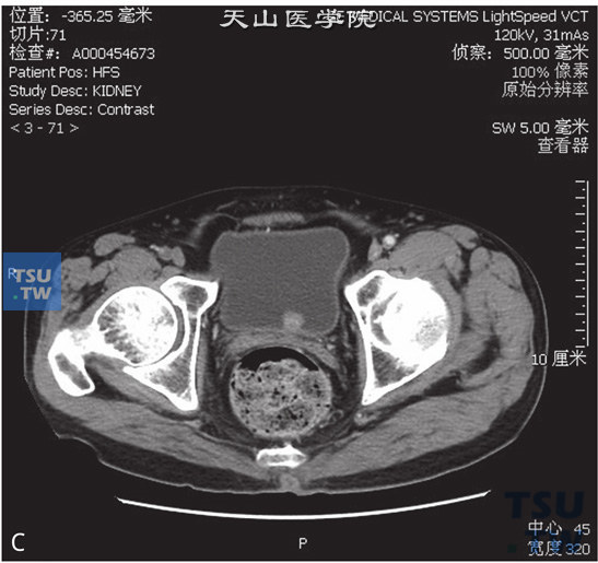 图C：CT膀胱移行上皮癌，男，62岁，全程无痛肉眼血尿1周。膀胱三角区见一蕈伞状软组织密度灶以窄基底与膀胱壁相连，边缘清晰，局部膀胱壁未见增厚，膀胱外缘光整