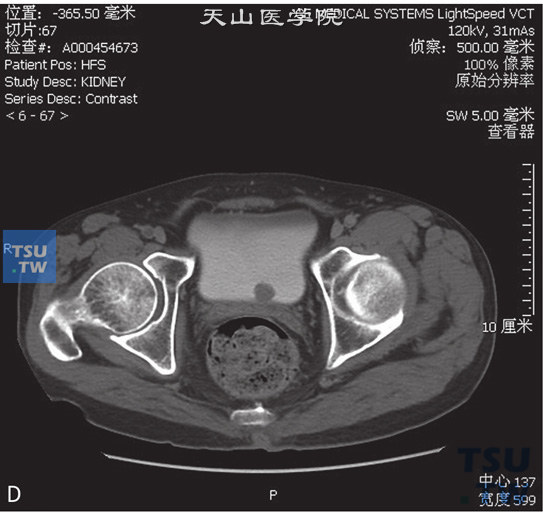 图D：CT膀胱移行上皮癌，男，62岁，全程无痛肉眼血尿1周。膀胱三角区见一蕈伞状软组织密度灶以窄基底与膀胱壁相连，边缘清晰，局部膀胱壁未见增厚，膀胱外缘光整