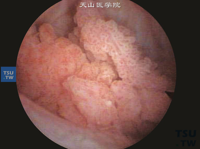 膀胱尿路上皮癌（膀胱镜所见）。示单发或多发的外生性乳头状肿物