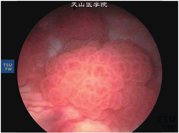 膀胱尿路上皮癌（膀胱镜所见）。示单发或多发的外生性乳头状肿物
