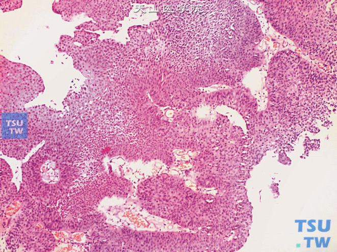 低级别尿路上皮癌，示细胞异型性不明显，极性略紊乱