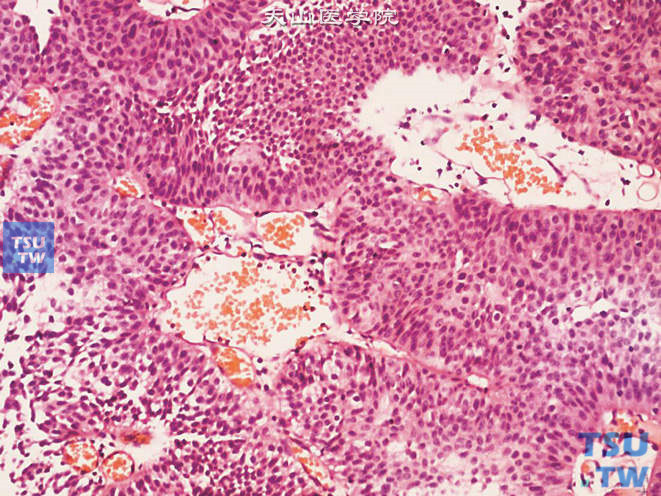 低级别尿路上皮癌，上图高倍，示细胞异型性不明显，极性略紊乱