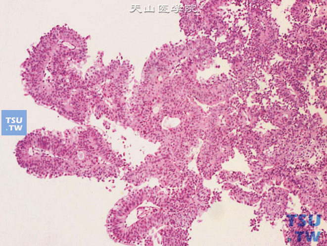 低级别尿路上皮癌，细胞极性好，伞细胞消失，乳头未融合