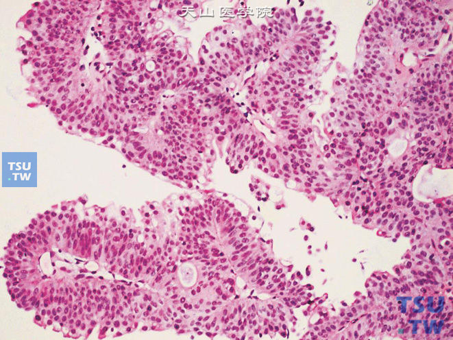 低级别尿路上皮癌，上图高倍，示细胞极性好，伞细胞消失，乳头未融合