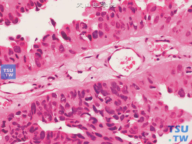 膀胱非浸润性乳头状尿路上皮癌，高级别。示核分裂象易见（共6个）。可见病理核分裂，且有的分裂象已远离基底层