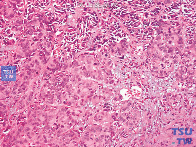 膀胱浸润性尿路上皮癌，表现为浸润性、有黏聚力的细胞巢。瘤细胞核形态多样，可成角、不规则。核分裂象易见