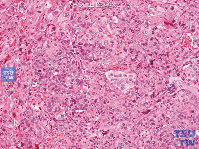浸润性尿路上皮癌，瘤细胞间变明显，细胞核多形性显著，可见奇异核，核分裂象多见