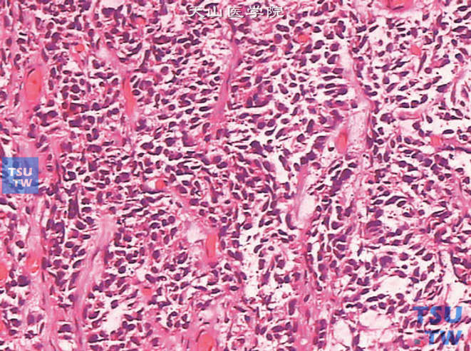 膀胱浸润性高级别尿路上皮癌，示肿瘤细胞呈巢片状分布