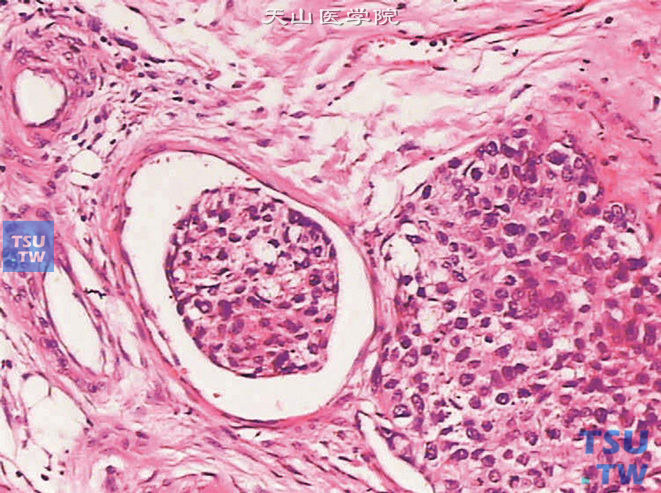 膀胱浸润性高级别尿路上皮癌，示脉管内瘤栓