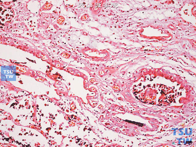 尿路上皮癌侵犯前列腺导管