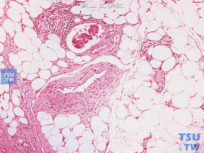 膀胱高级别浸润性尿路上皮癌，膀胱周围脂肪组织中可见血管内瘤栓