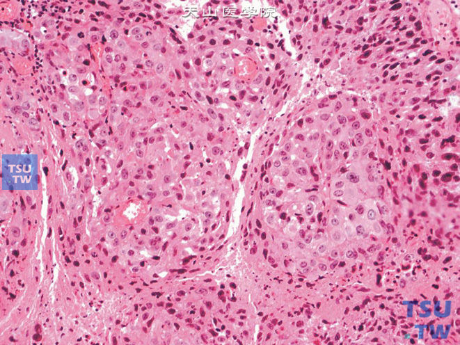 浸润性尿路上皮癌伴鳞化，细胞界限清楚，可见小核仁