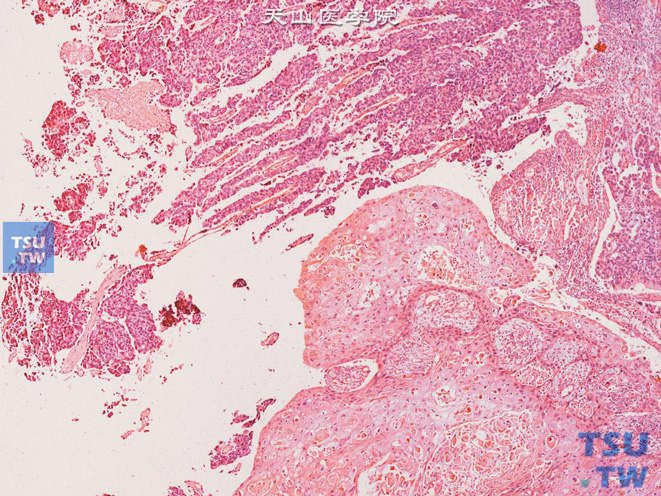 膀胱典型的乳头状尿路上皮癌与典型的鳞癌并存，诊断为尿路上皮癌伴鳞化