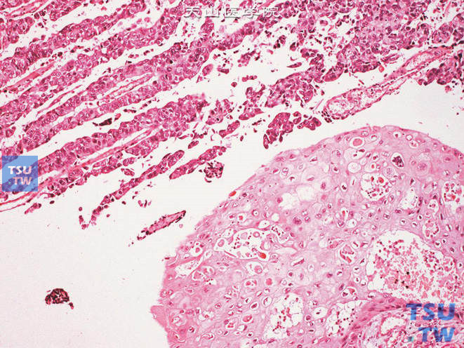 膀胱典型的乳头状尿路上皮癌与典型的鳞癌并存，鳞癌区域可见角化。诊断为尿路上皮癌伴鳞化