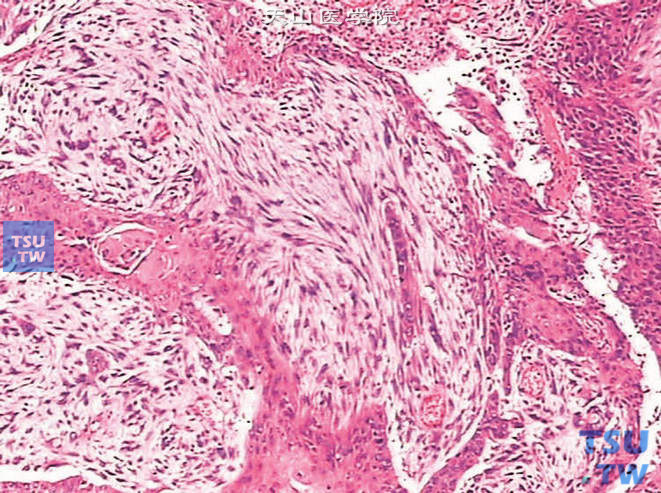 膀胱浸润性高级别尿路上皮癌，伴鳞化及肉瘤样分化。可见黏液样间质及鳞化