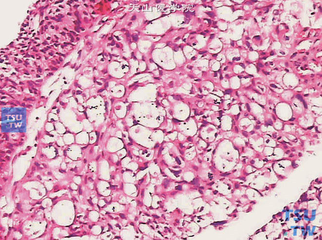 浸润性尿路上皮癌，伴腺样分化，可见印戒细胞
