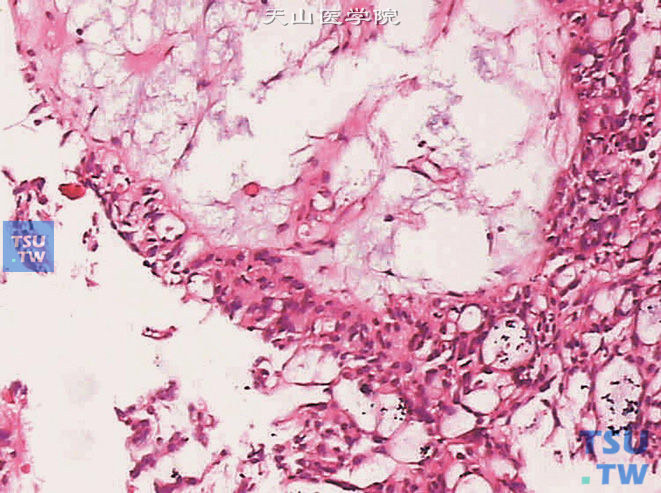 浸润性尿路上皮癌，伴腺样分化，可见黏液湖