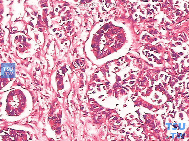 膀胱浸润性高级别尿路上皮癌，伴腺性分化。可见真正的腺性成分。上图高倍。细胞呈立方或高柱状