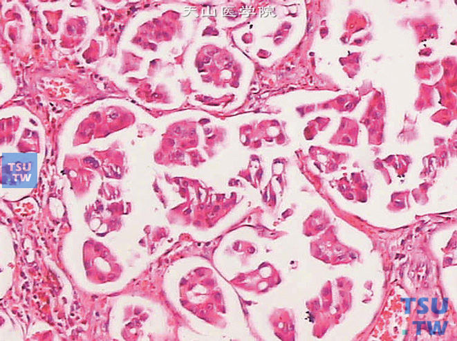 膀胱浸润性高级别尿路上皮癌，伴腺性分化。可见腺腔形成