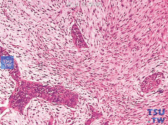 膀胱浸润性高级别尿路上皮癌，肉瘤样变异型。可见黏液样间质及未分化梭形细胞肉瘤样成分