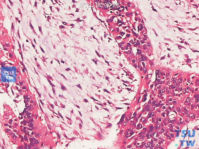 膀胱浸润性高级别尿路上皮癌，肉瘤样变异型。上图高倍。可见黏液样间质及未分化梭形细胞肉瘤样成分。梭形细胞可见异型性，核仁明显