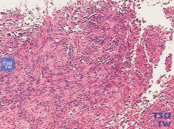 膀胱浸润性高级别尿路上皮癌，肉瘤样变异型。示呈肉瘤样表现的梭形细胞