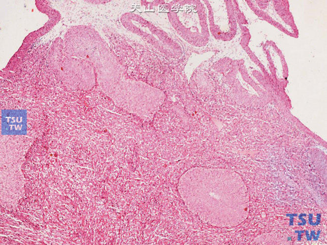 浸润性尿路上皮癌，伴肉瘤样分化。示局部肿瘤细胞呈梭形