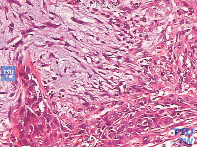 膀胱浸润性高级别尿路上皮癌，肉瘤样变异型。示明显的黏液样间质