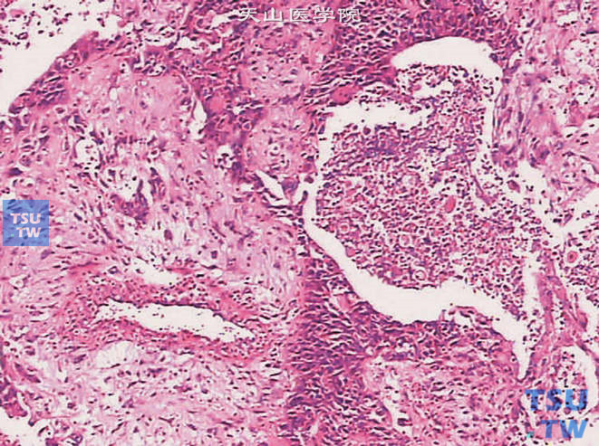 膀胱浸润性高级别尿路上皮癌，伴鳞化及肉瘤样分化。可见鳞状细胞及呈肉瘤样表现的梭形细胞