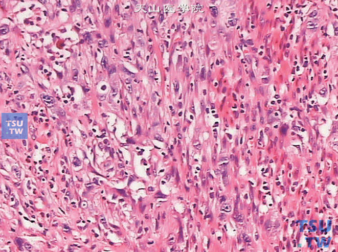 膀胱浸润性高级别尿路上皮癌，肉瘤样变异型。示肿瘤细胞异型性明显，大部分呈梭形