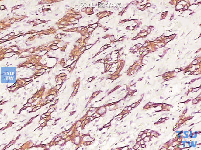 膀胱浸润性高级别尿路上皮癌，肉瘤样变异型。免疫组化染色：CK7阳性