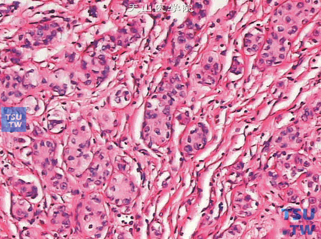 膀胱浸润性高级别尿路上皮癌，巢状变异型。示肿瘤细胞呈巢状分布，类似于Brunn巢。细胞异型性不明显
