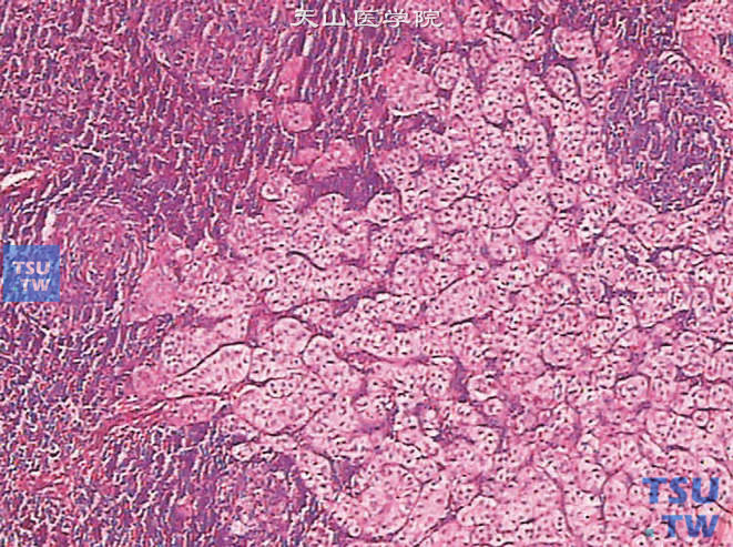 膀胱浸润性高级别尿路上皮癌，巢状变异型，转移至淋巴结