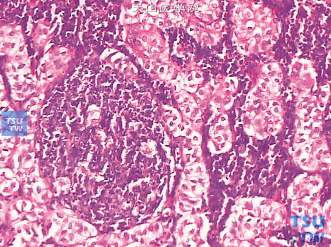 膀胱浸润性高级别尿路上皮癌，巢状变异型，转移至淋巴结。上图高倍。示肿瘤细胞核小，异型性不明显