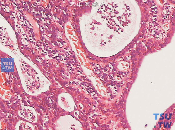 膀胱浸润性高级别尿路上皮癌，微囊变异型。可见明显的囊状结构，囊腔为圆形或卵圆形。内衬上皮为尿路上皮