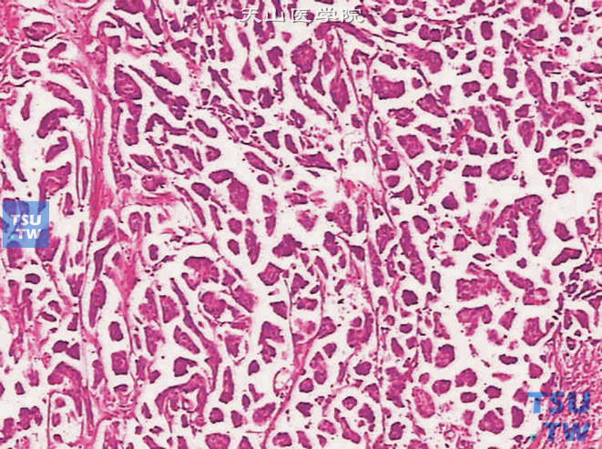 膀胱浸润性高级别尿路上皮癌，微乳头变异型。肿瘤由纤细的乳头构成