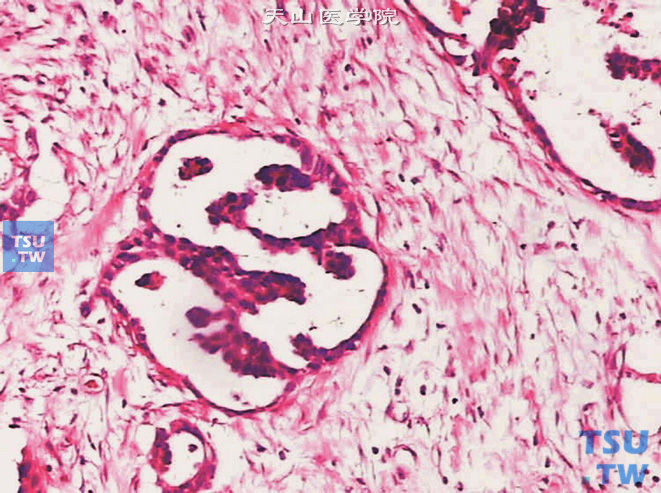 膀胱浸润性高级别尿路上皮癌，微乳头变异型。示横切面表现为肾小球样结构