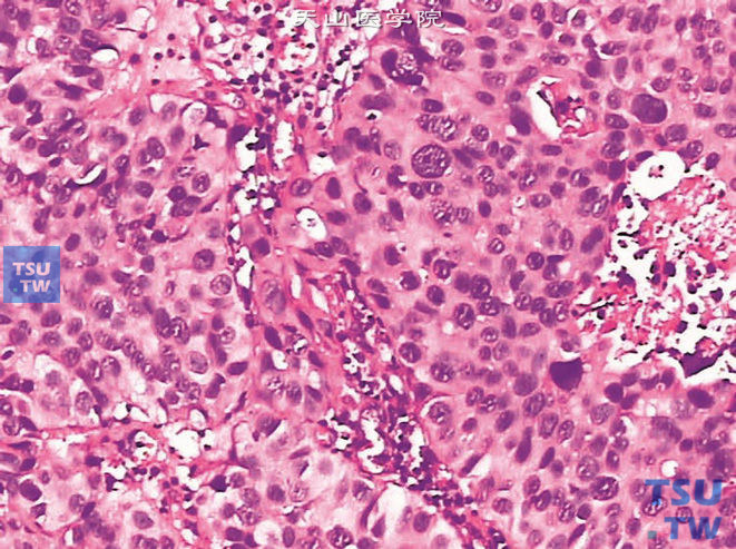 膀胱浸润性高级别尿路上皮癌，伴上皮性瘤巨细胞