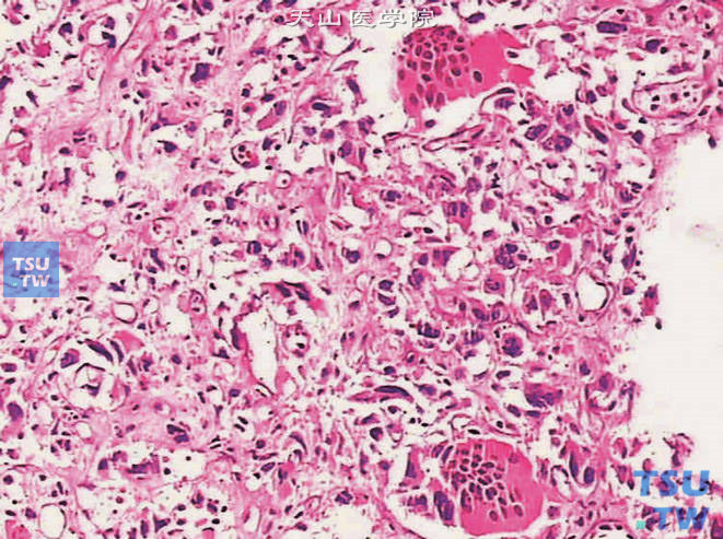 浸润性尿路上皮癌，可见多核巨细胞。周围可见呈肉瘤样分化的肿瘤细胞