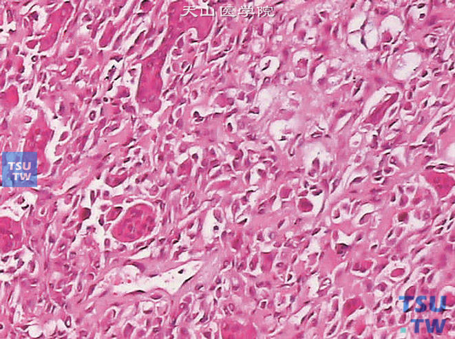 浸润性尿路上皮癌，伴破骨细胞样巨细胞