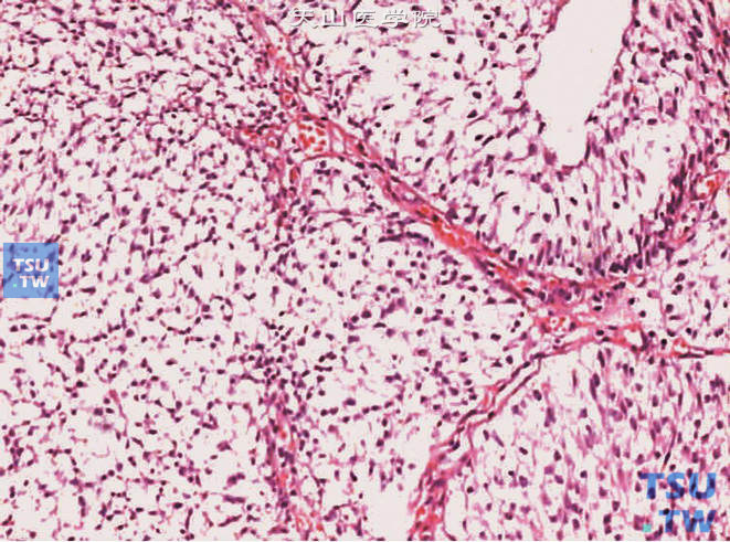 膀胱尿路上皮癌，透明细胞亚型，示胞质透明