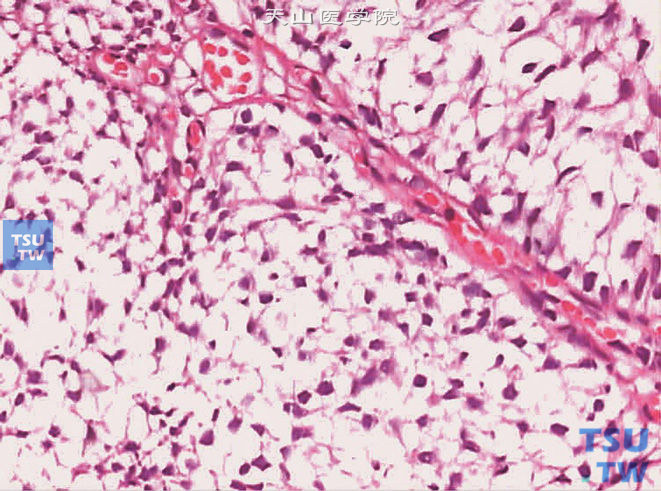 膀胱尿路上皮癌，透明细胞亚型，上图高倍，示胞质透明